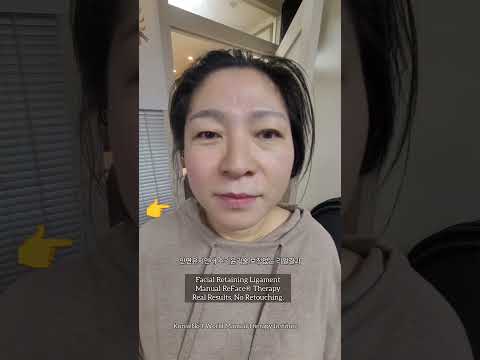 안면유지인대 수기윤곽술 단 1회 3분 리얼결..
